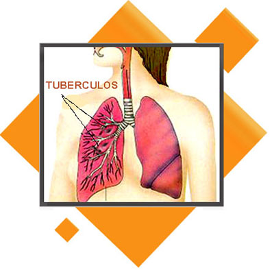 Tuberculosis