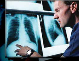 LUNG CANCER SCREENING