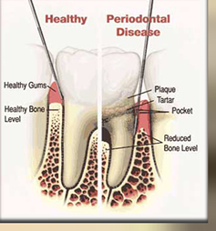 GUM DISEASE