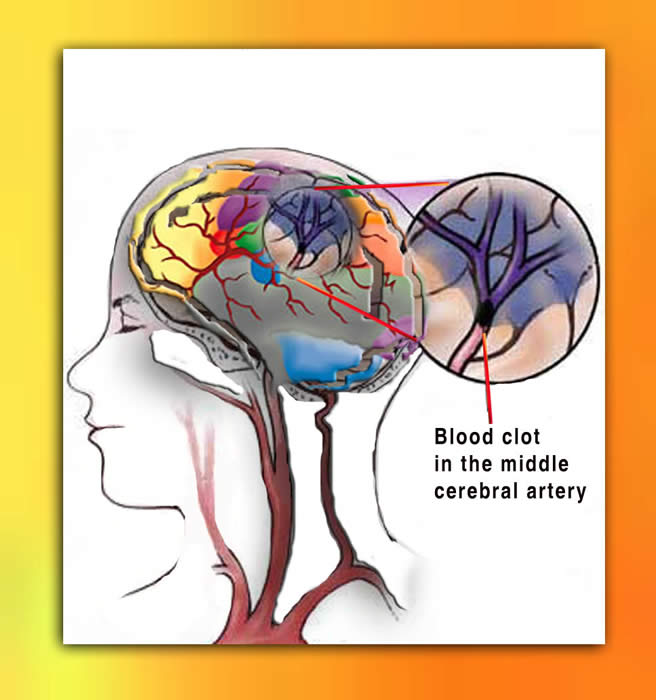 Stroke English graphic