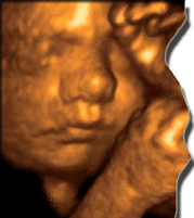 ABORTIONS