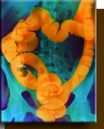 Colorectal cancer 