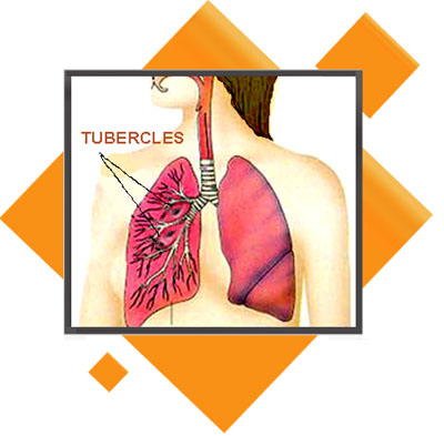 TUBERCULOSIS